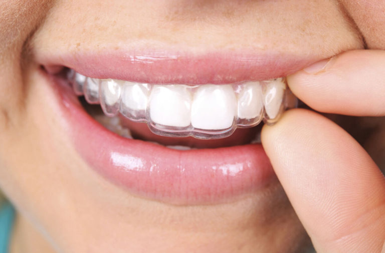 Przezroczyste aparaty Clear Aligner w Gdyni i Gdańsku