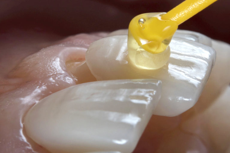 Licówki zębowe w Gdyni i Gdańsku