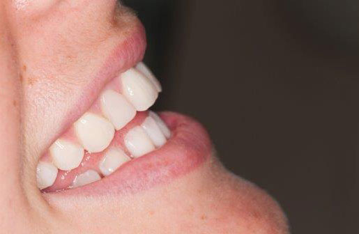  - zdjęcie po zabiegu stomatologicznym